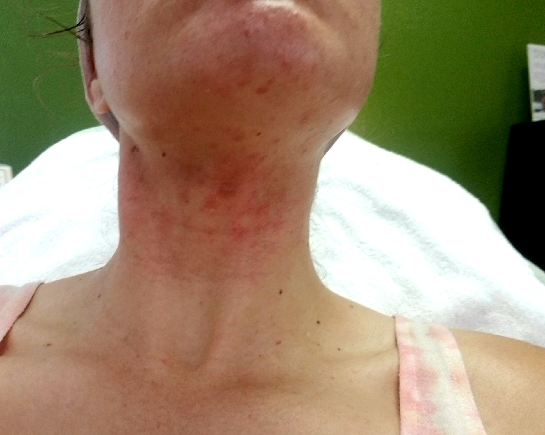 Sumer with acne on her neck